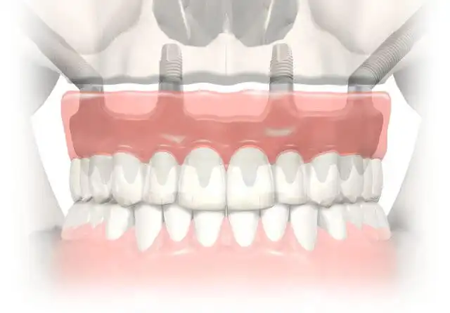 深圳全口種植牙
