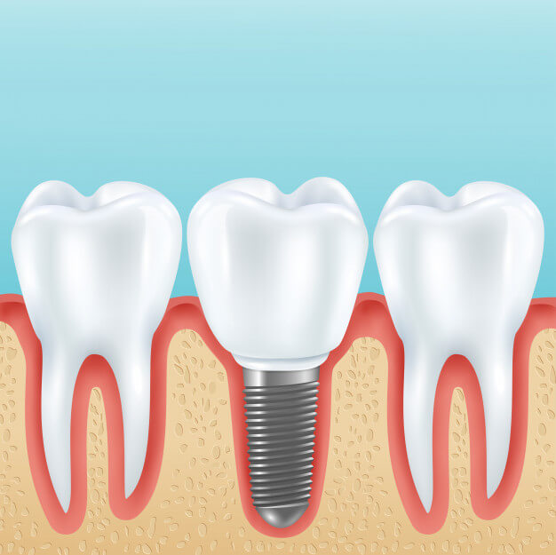 vickongdental_implant2