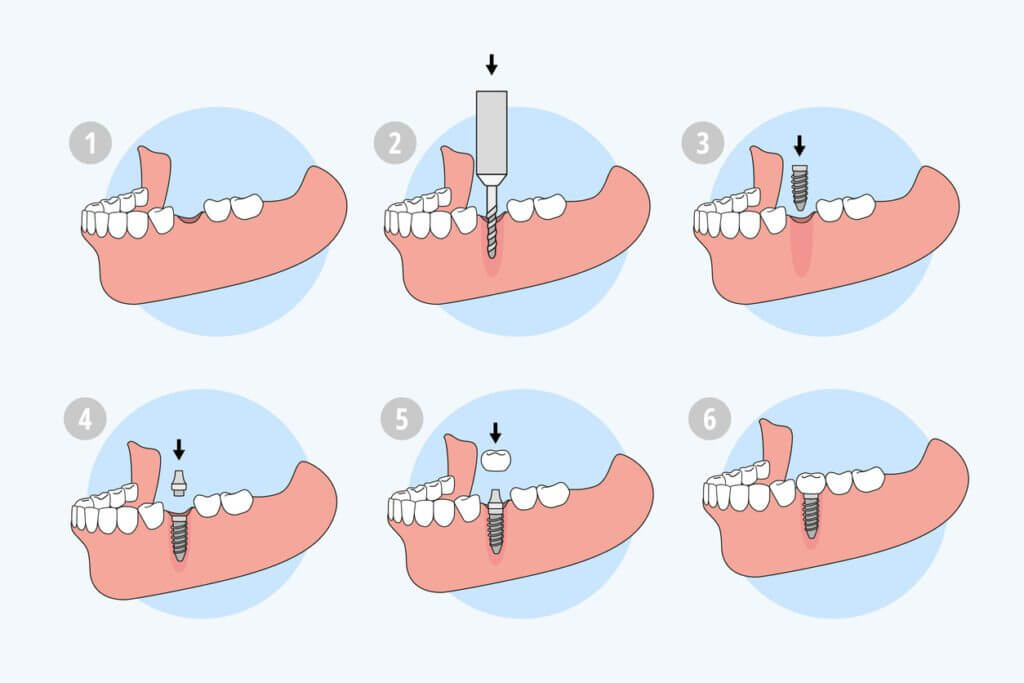 vickongdental_implant5.jpg