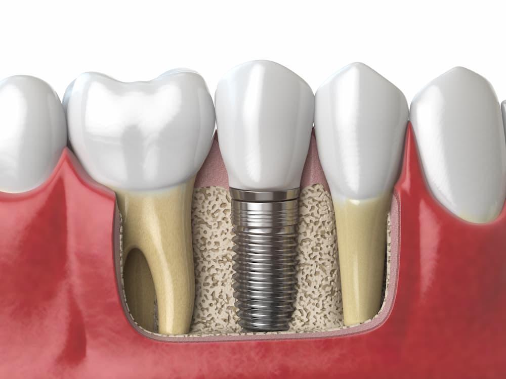 vickongdental_implant11.jpg