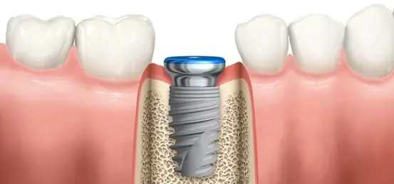 vickongdental_implant7.jpg