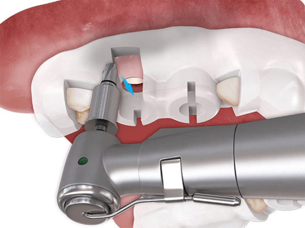 vickongdental_implant6.jpg