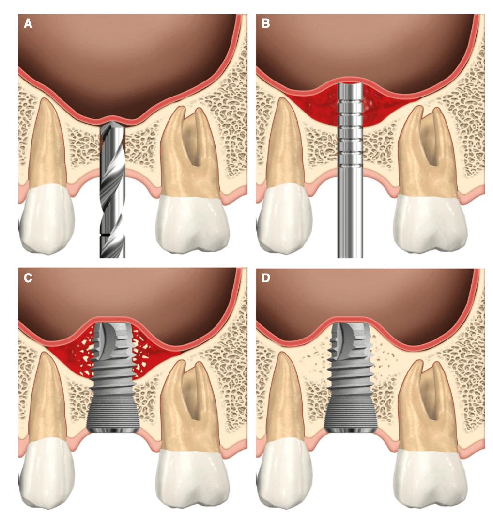 vickongdental_implant13.jpg