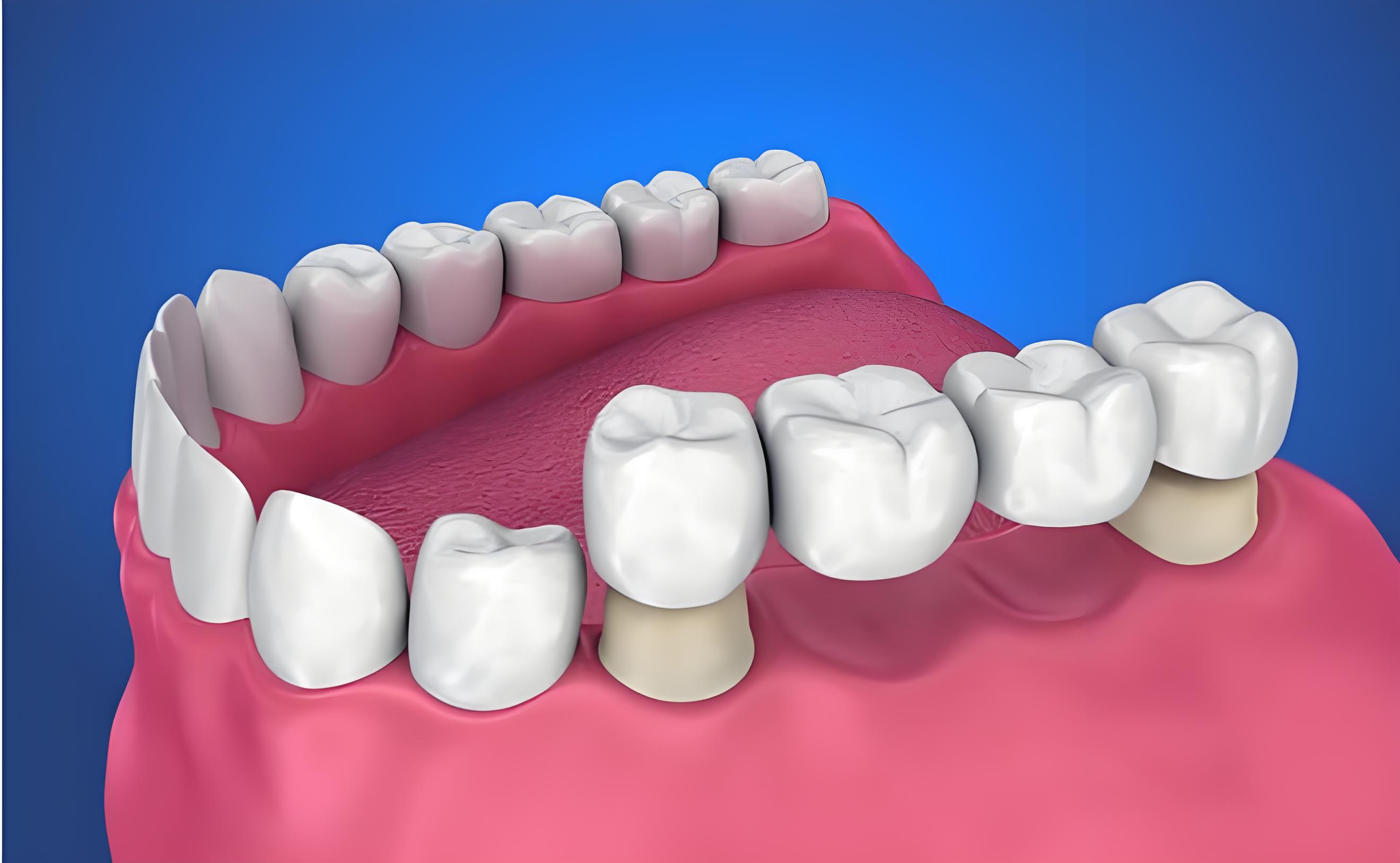 瓷牙套修復牙齒缺失.jpg 瓷牙套修復牙齒缺失.jpg