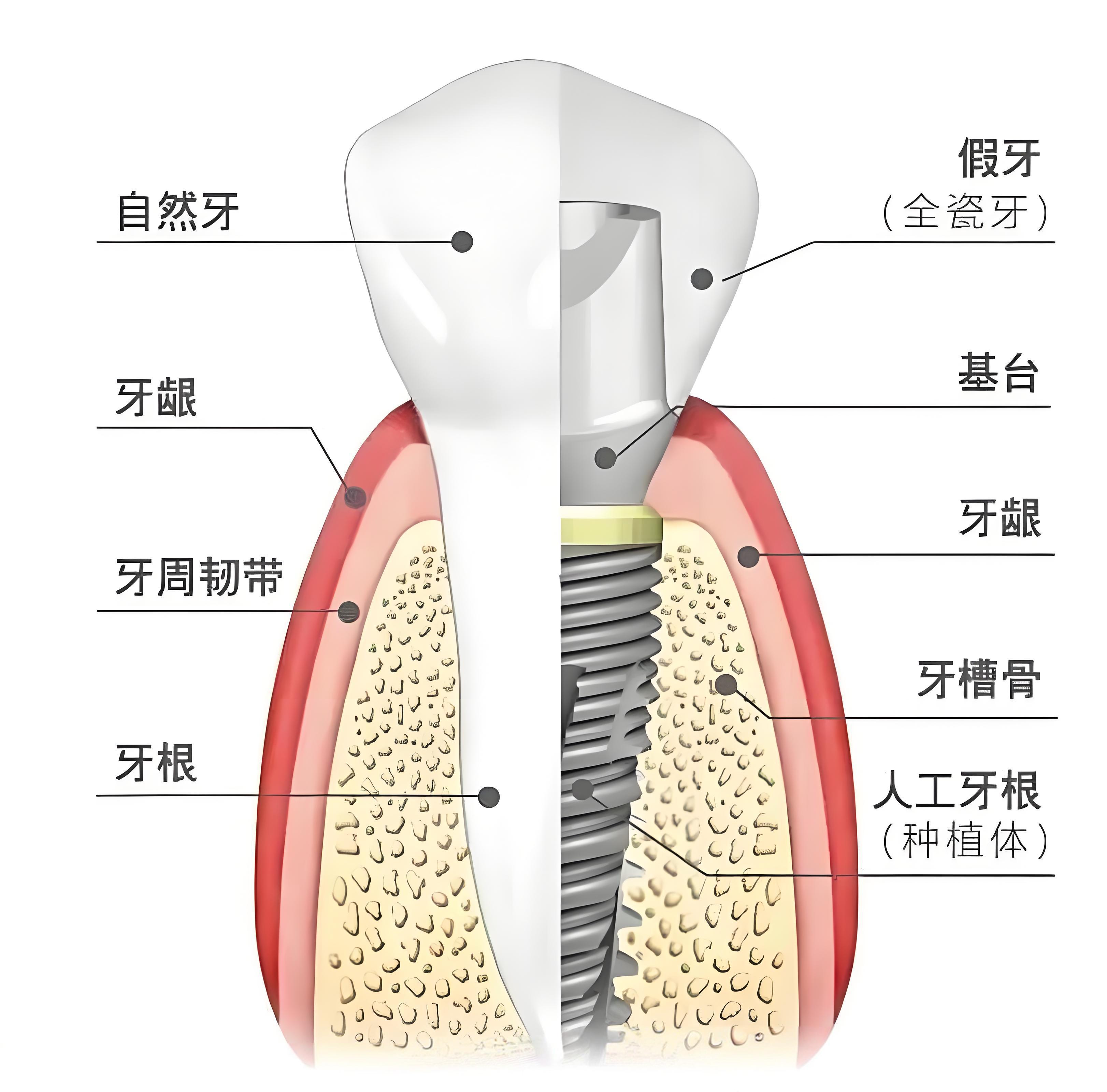 種植牙組成部分 種植牙組成部分