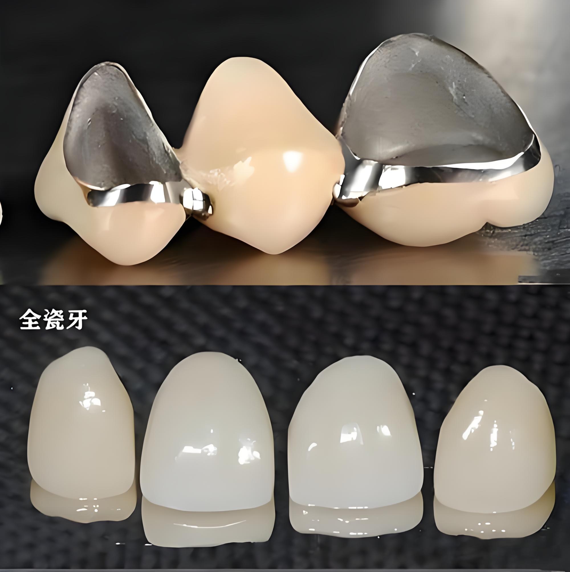 全瓷牙和烤瓷牙